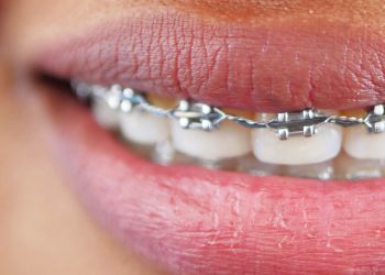 BIEN ÊTRE : Sourire de tout son appareil dentaire