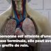 SANTE – La greffe des reins n’est pas pour tous les patients atteints d’insuffisance rénale