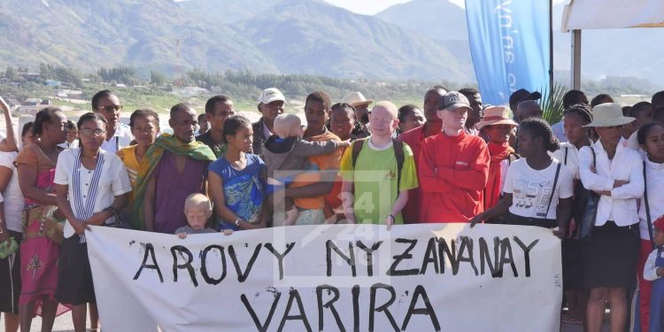 DROITS DE L’HOMME – Plus de 13 cas d’enlèvements et un cas de meurtre d’enfants atteints d’albinisme enregistrés ces deux dernières années dans le Sud de Madagascar