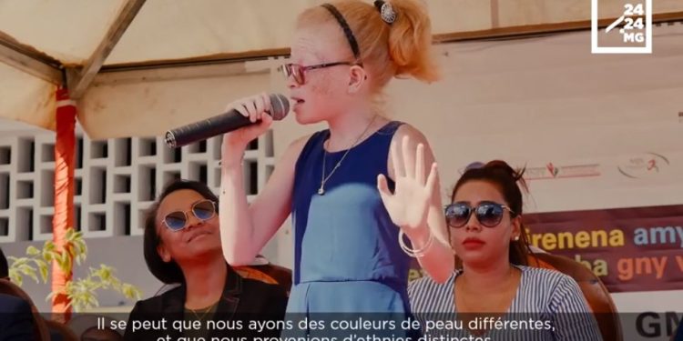 SOCIETE – Le quotidien difficile des personnes atteintes d&rsquo;albinisme dans le Sud de Madagascar