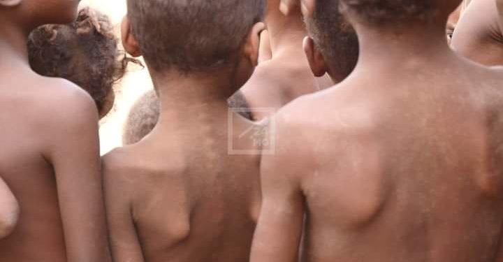 NUTRITION – 8,8 millions de Malgaches soit environ 33% de la population de Madagascar en situation d’insécurité alimentaire, selon la présentation de la Banque mondiale