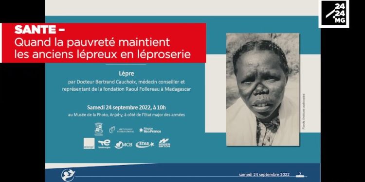 SANTE – Quand la pauvreté maintient les anciens lépreux en léproserie