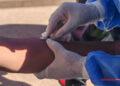 EPIDÉMIE – Deux nouveaux décès liés à la Mpox et une centaine de guérisons en trois jours
